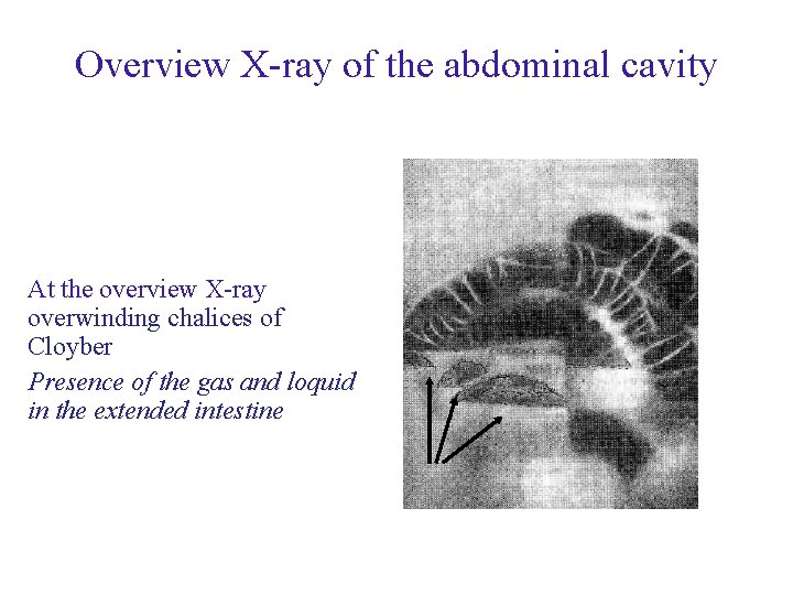 Overview X-ray of the abdominal cavity At the overview X-ray overwinding chalices of Cloyber Overview X-ray of the abdominal cavity At the overview X-ray overwinding chalices of Cloyber