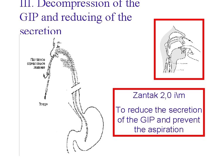III. Decompression of the GIP and reducing of the secretion Zantak 2, 0 im III. Decompression of the GIP and reducing of the secretion Zantak 2, 0 im