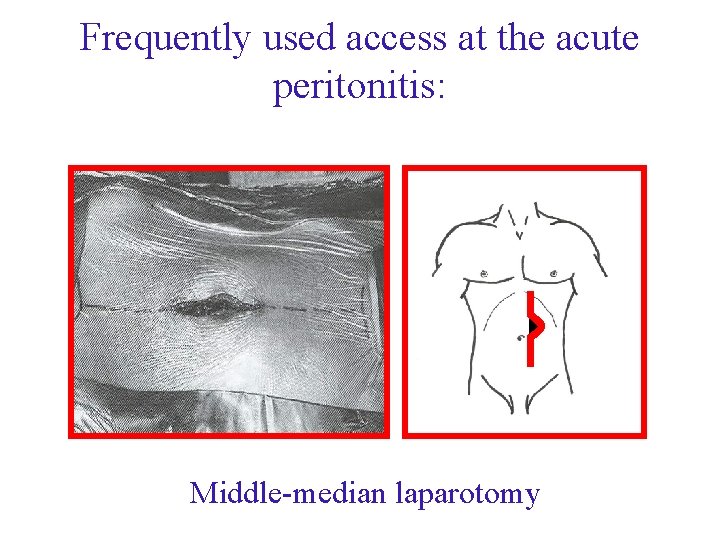 Frequently used access at the acute peritonitis: Middle-median laparotomy Frequently used access at the acute peritonitis: Middle-median laparotomy