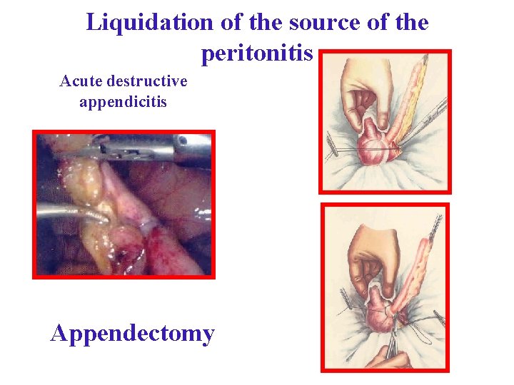 Liquidation of the source of the peritonitis Acute destructive appendicitis Appendectomy Liquidation of the source of the peritonitis Acute destructive appendicitis Appendectomy