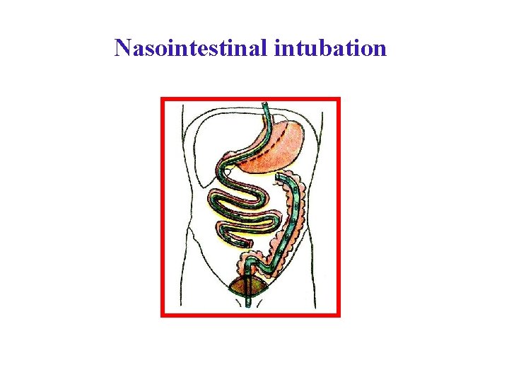 Nasointestinal intubation Nasointestinal intubation