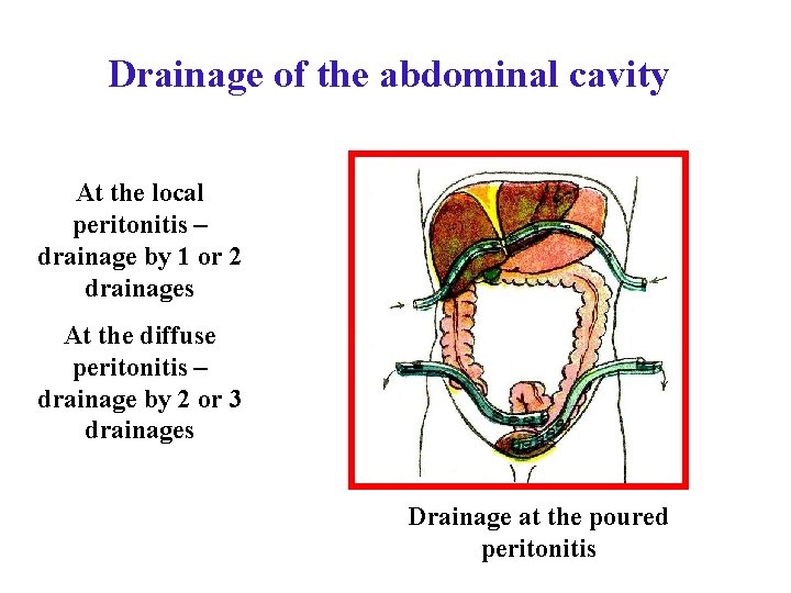 Drainage of the abdominal cavity At the local peritonitis – drainage by 1 or Drainage of the abdominal cavity At the local peritonitis – drainage by 1 or