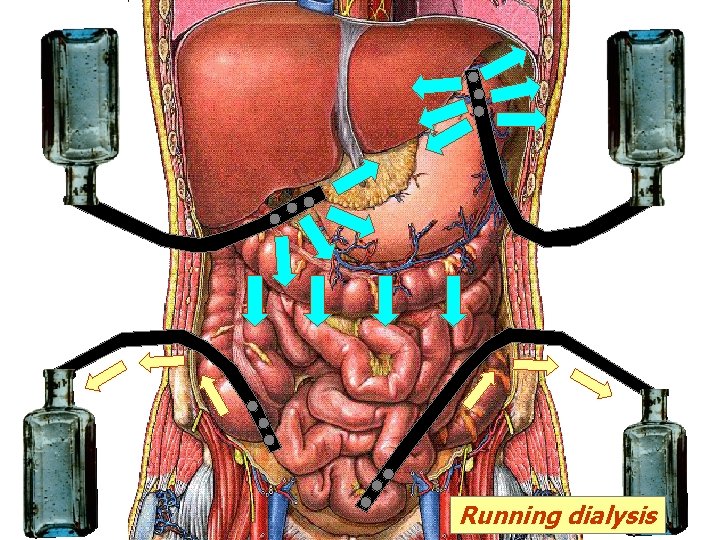 я Running dialysis я Running dialysis