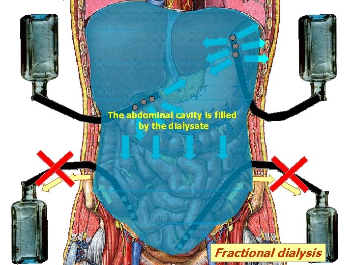 я The abdominal cavity is filled by the dialysate Fractional dialysis я The abdominal cavity is filled by the dialysate Fractional dialysis
