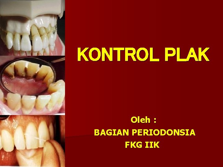 KONTROL PLAK Oleh : BAGIAN PERIODONSIA FKG IIK 