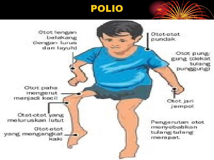 POLIO 