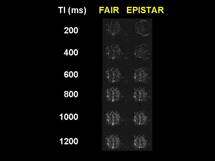 TI (ms) 200 400 600 800 1000 1200 FAIR EPISTAR 