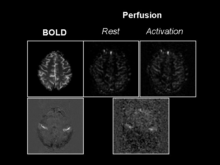 Perfusion BOLD Rest Activation 
