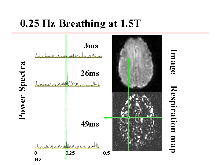 0. 25 Hz Breathing at 1. 5 T 26 ms 49 ms 0 Hz