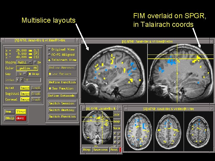 Multislice layouts FIM overlaid on SPGR, in Talairach coords 