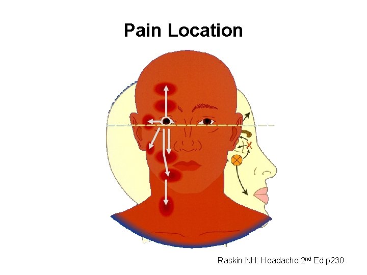 Pain Location Raskin NH: Headache 2 nd Ed p 230 