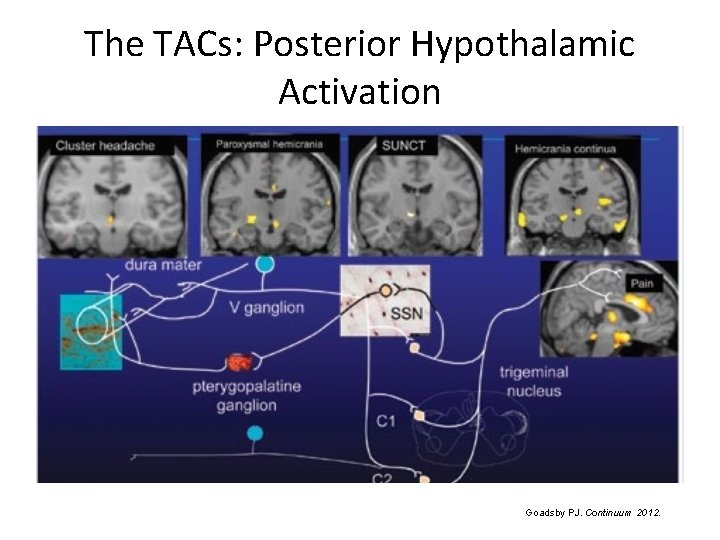 The TACs: Posterior Hypothalamic Activation Goadsby PJ. Continuum 2012. 