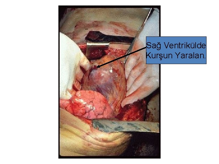 Sağ Ventrikülde Kurşun Yaralan. 