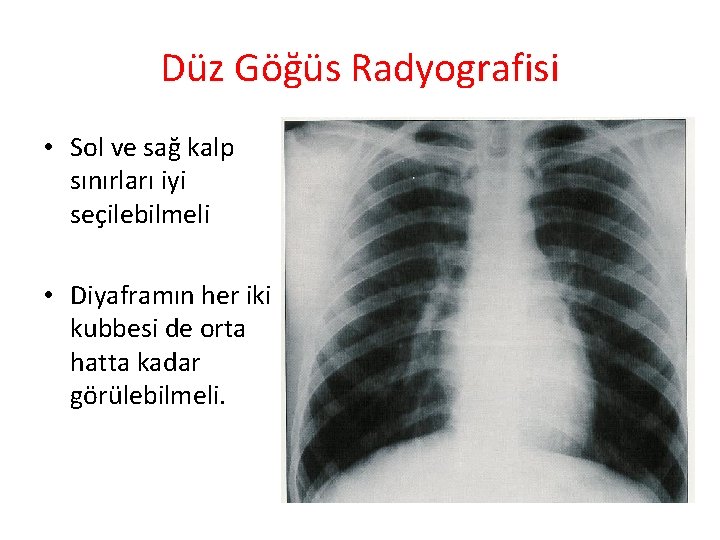 Düz Göğüs Radyografisi • Sol ve sağ kalp sınırları iyi seçilebilmeli • Diyaframın her