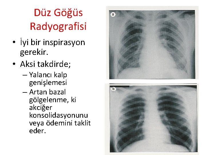 Düz Göğüs Radyografisi • İyi bir inspirasyon gerekir. • Aksi takdirde; – Yalancı kalp