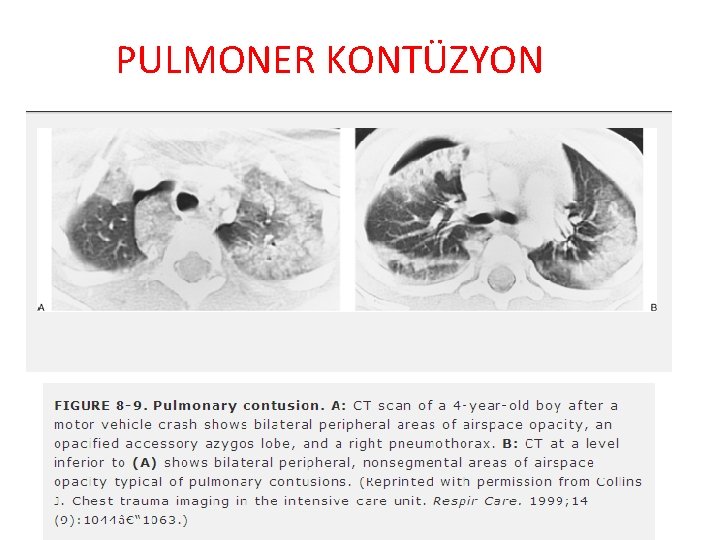 PULMONER KONTÜZYON 