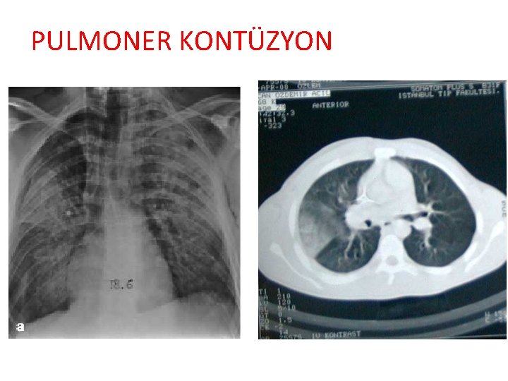 PULMONER KONTÜZYON 