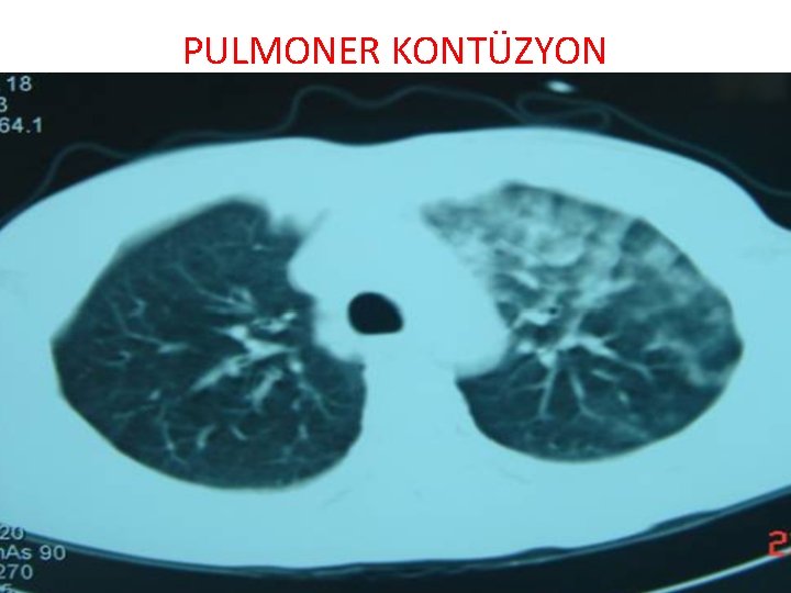 PULMONER KONTÜZYON 