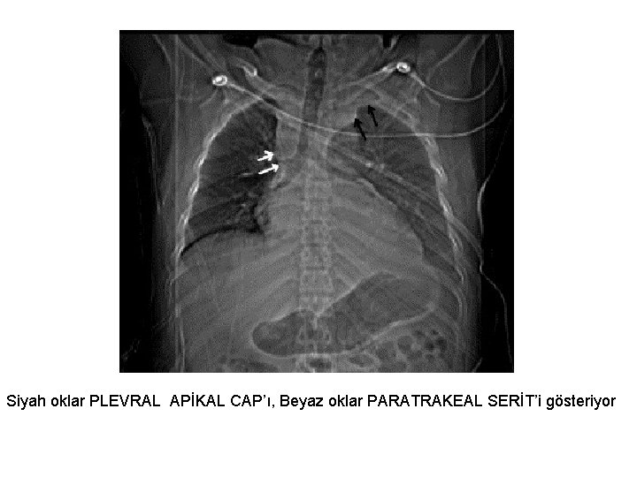 Siyah oklar PLEVRAL APİKAL CAP’ı, Beyaz oklar PARATRAKEAL SERİT’i gösteriyor 