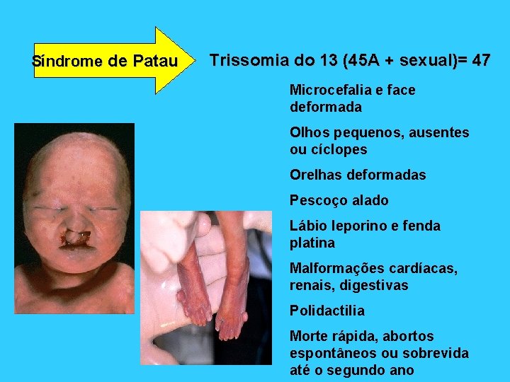 Síndrome de Patau Trissomia do 13 (45 A + sexual)= 47 Microcefalia e face