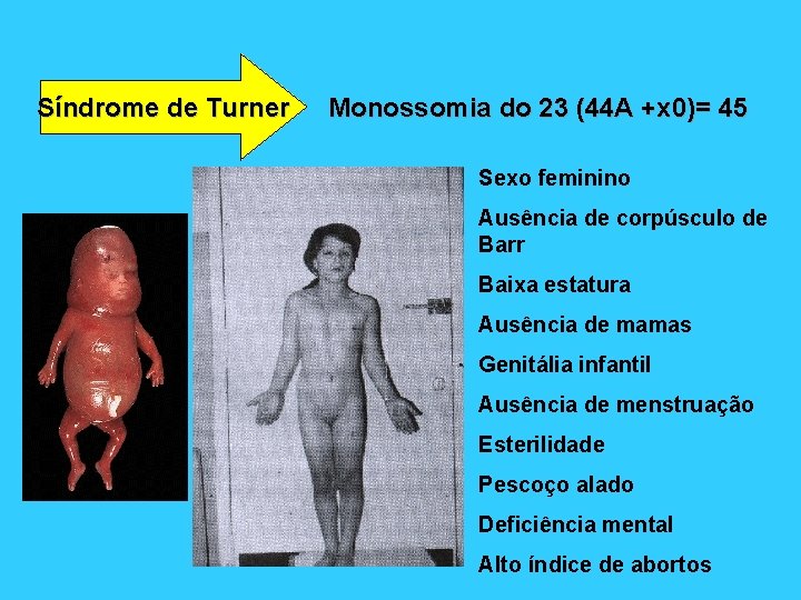 Síndrome de Turner Monossomia do 23 (44 A +x 0)= 45 Sexo feminino Ausência