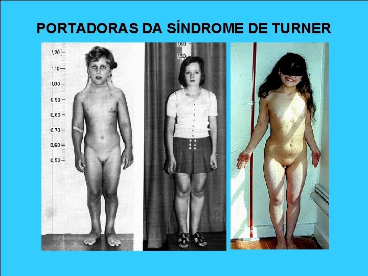 PORTADORAS DA SÍNDROME DE TURNER 