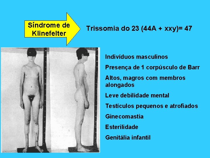 Síndrome de Klinefelter Trissomia do 23 (44 A + xxy)= 47 Indivíduos masculinos Presença