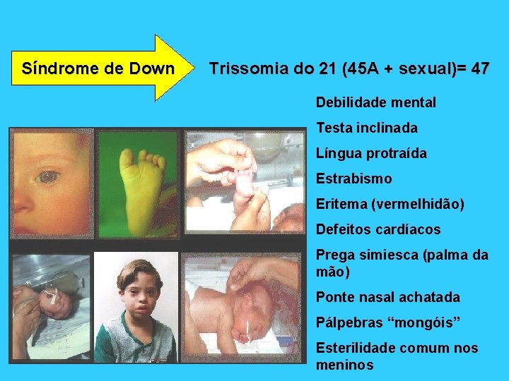 Síndrome de Down Trissomia do 21 (45 A + sexual)= 47 Debilidade mental Testa