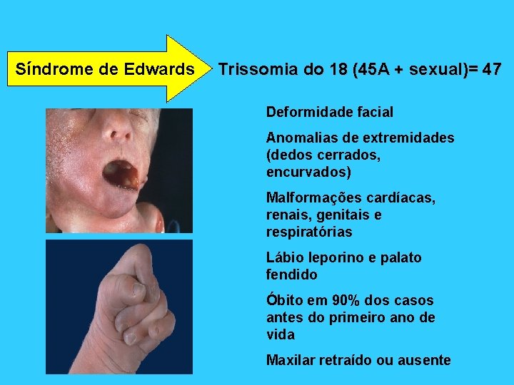 Síndrome de Edwards Trissomia do 18 (45 A + sexual)= 47 Deformidade facial Anomalias