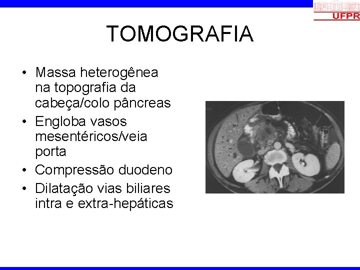 TOMOGRAFIA • Massa heterogênea na topografia da cabeça/colo pâncreas • Engloba vasos mesentéricos/veia porta