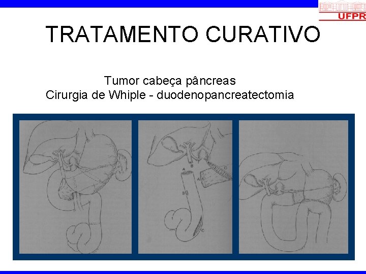 TRATAMENTO CURATIVO Tumor cabeça pâncreas Cirurgia de Whiple - duodenopancreatectomia 
