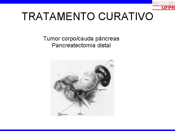 TRATAMENTO CURATIVO Tumor corpo/cauda pâncreas Pancreatectomia distal 