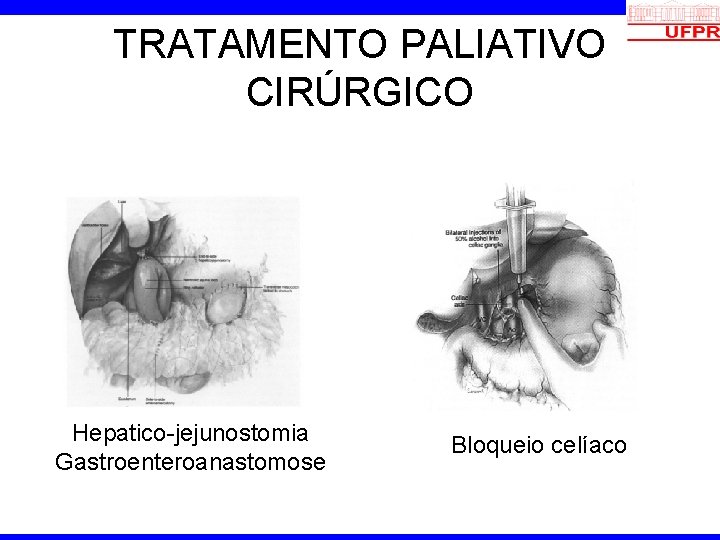 TRATAMENTO PALIATIVO CIRÚRGICO Hepatico-jejunostomia Gastroenteroanastomose Bloqueio celíaco 