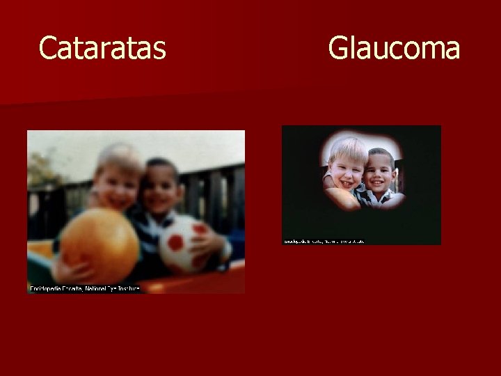 Cataratas Glaucoma 