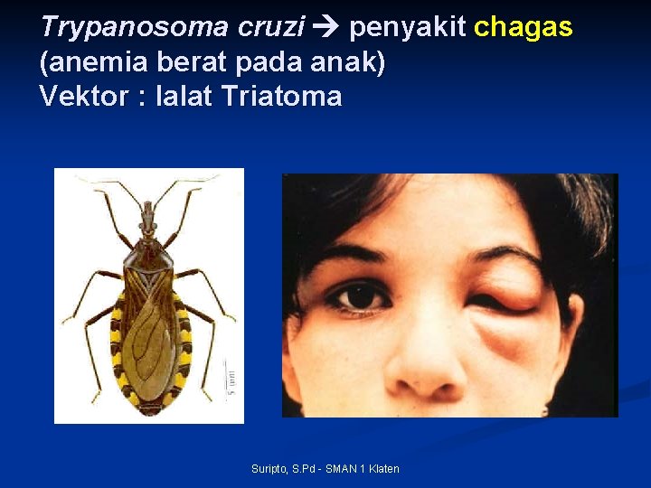 Trypanosoma cruzi penyakit chagas (anemia berat pada anak) Vektor : lalat Triatoma Suripto, S.