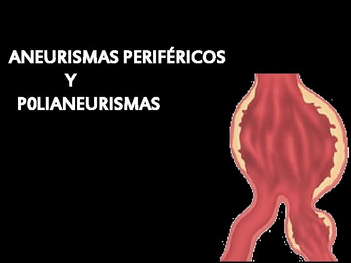 ANEURISMAS PERIFÉRICOS Y P 0 LIANEURISMAS 