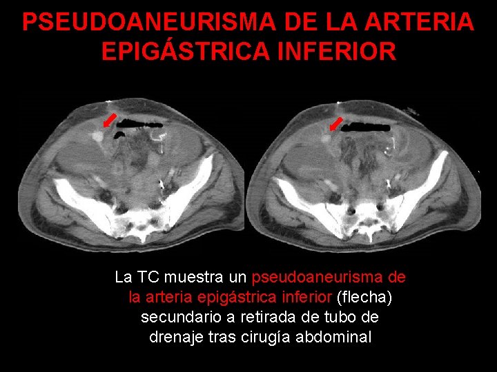 PSEUDOANEURISMA DE LA ARTERIA EPIGÁSTRICA INFERIOR La TC muestra un pseudoaneurisma de la arteria