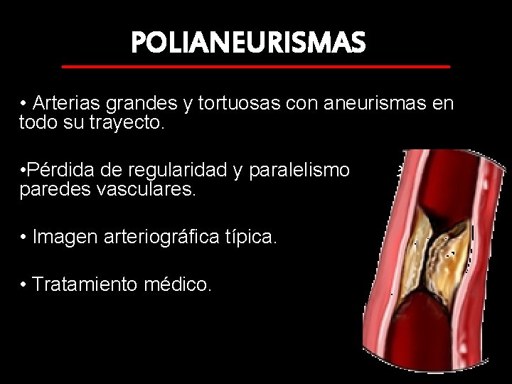 POLIANEURISMAS • Arterias grandes y tortuosas con aneurismas en todo su trayecto. • Pérdida