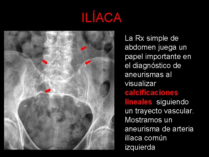ILÍACA La Rx simple de abdomen juega un papel importante en el diagnóstico de