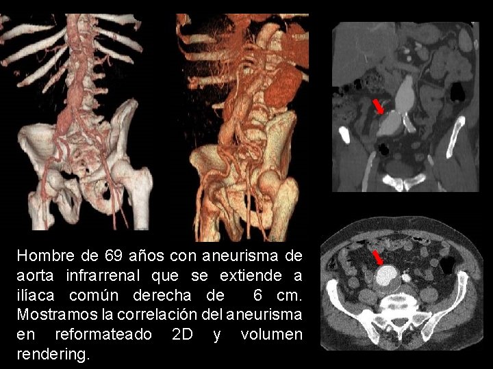 Hombre de 69 años con aneurisma de aorta infrarrenal que se extiende a ilíaca