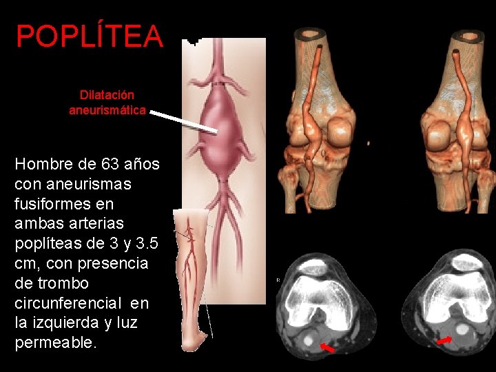 POPLÍTEA Dilatación aneurismática Hombre de 63 años con aneurismas fusiformes en ambas arterias poplíteas