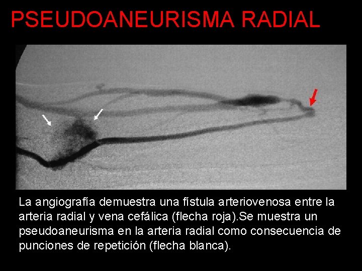 PSEUDOANEURISMA RADIAL La angiografía demuestra una fístula arteriovenosa entre la arteria radial y vena