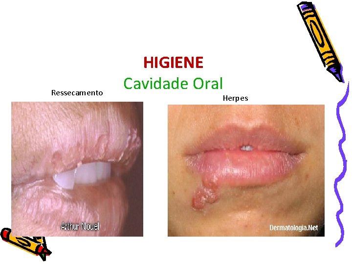 Ressecamento HIGIENE Cavidade Oral Herpes 