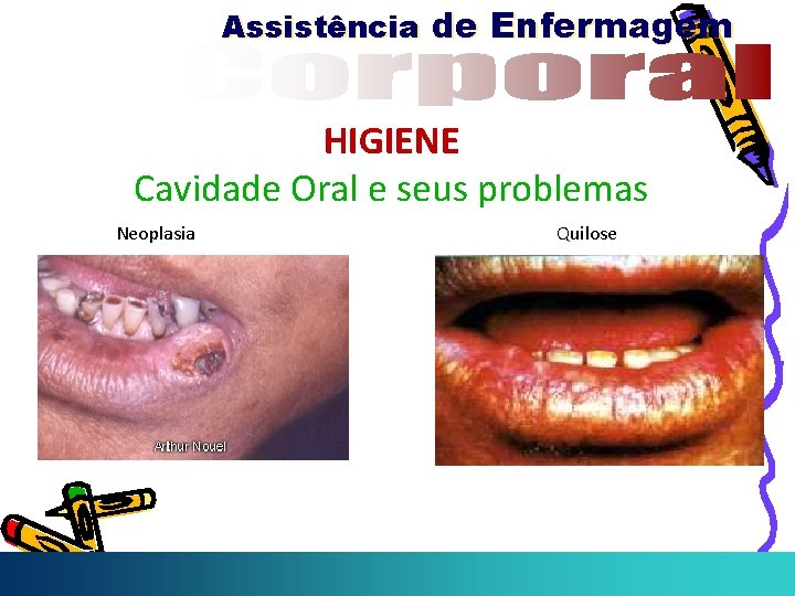 Assistência de Enfermagem HIGIENE Cavidade Oral e seus problemas Neoplasia Quilose 