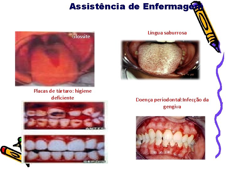 Gengivite Assistência de Enfermagem Queilose Glossite Placas de tártaro: higiene deficiente Língua saburrosa Doença