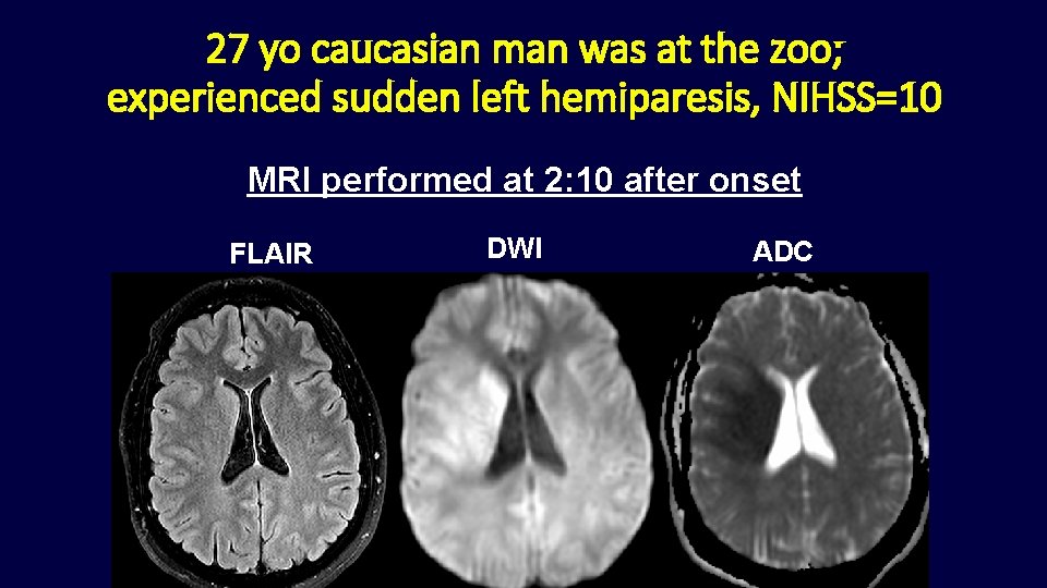27 yo caucasian man was at the zoo; experienced sudden left hemiparesis, NIHSS=10 MRI