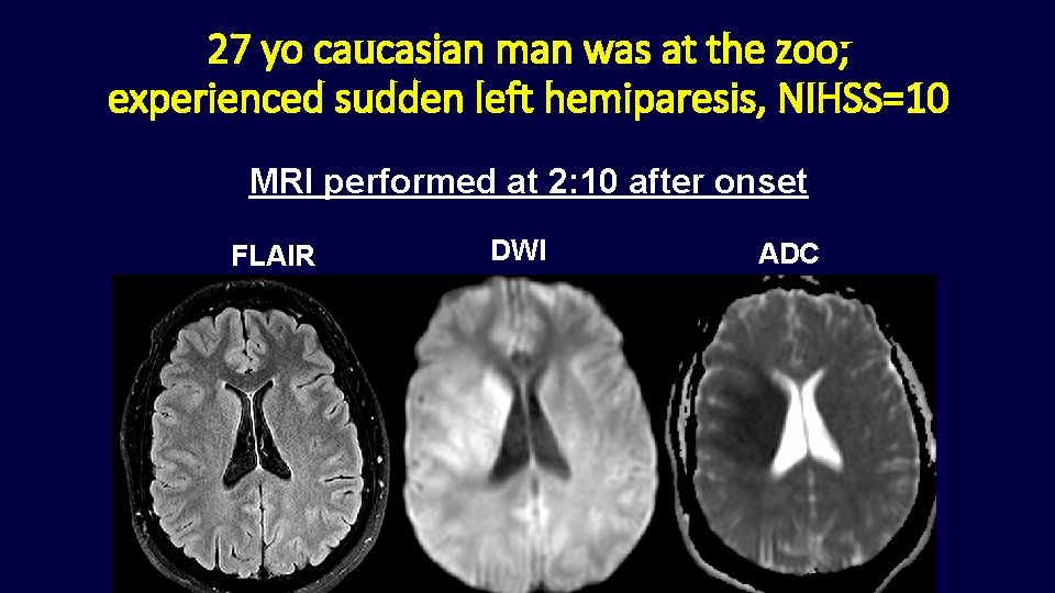 27 yo caucasian man was at the zoo; experienced sudden left hemiparesis, NIHSS=10 MRI