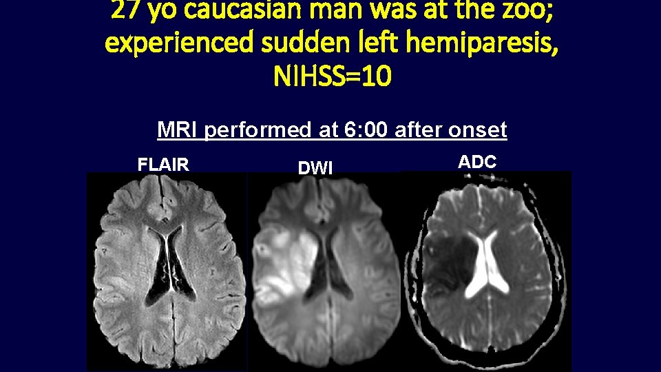 27 yo caucasian man was at the zoo; experienced sudden left hemiparesis, NIHSS=10 MRI