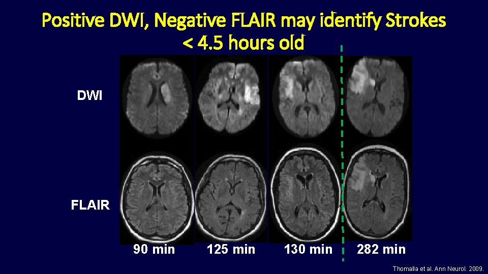 Positive DWI, Negative FLAIR may identify Strokes < 4. 5 hours old DWI FLAIR