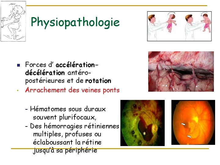 Physiopathologie n • Forces d’ accélérationdécélération antéropostérieures et de rotation Arrachement des veines ponts